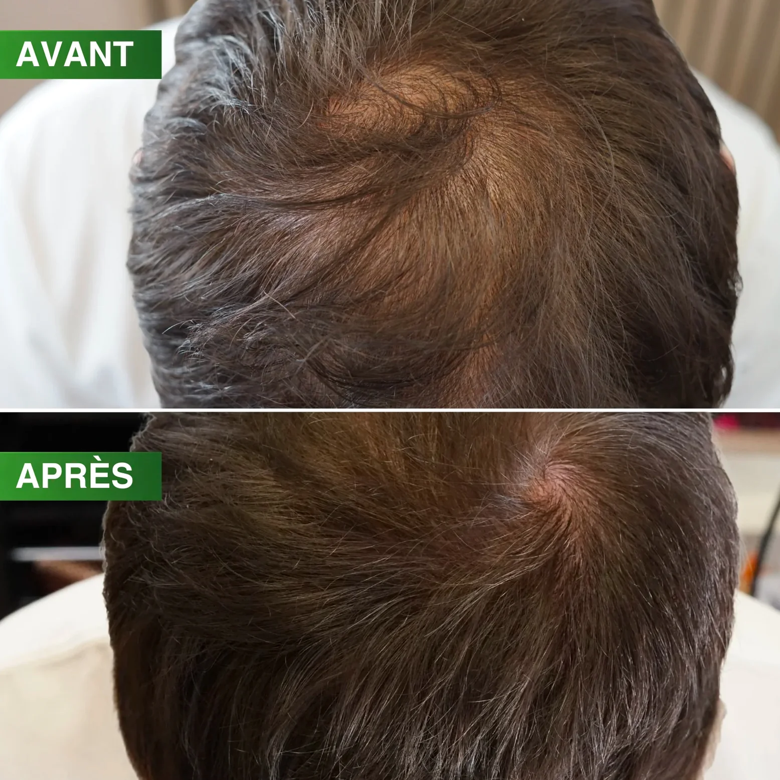 Dermaroller Densité Pro BBHAIR Generik - Image 3